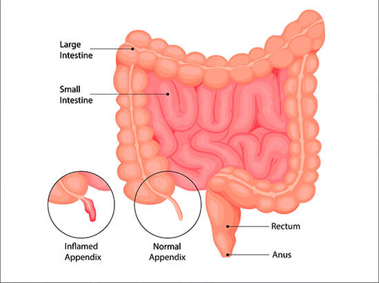 Appendicitis surgery