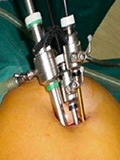 Single Incision Lap. Surgery
