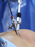 Key Hole Surgery