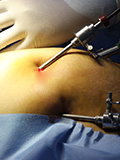Major GI Surgery