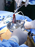 Gall Bladder Stones