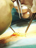 Hernia Repair