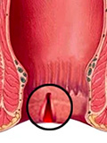 Fissure-In-ANO
