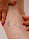 Varicose Veins
