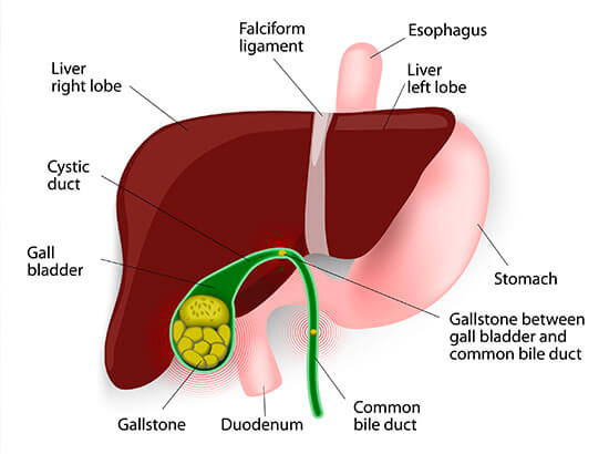 Treatment of Gall Bladder Stones