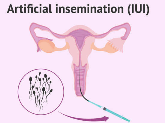 Intrauterine Insemination