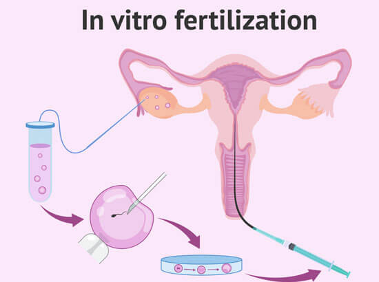 IVF/ Test Tube Baby