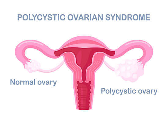 PCOS / PCOD