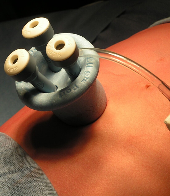 Single Incision Laparoscopic Surgery (SILS) by Dr. Amit Pande