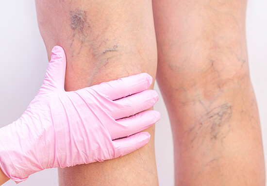 Varicose Veins doctor saharanpur